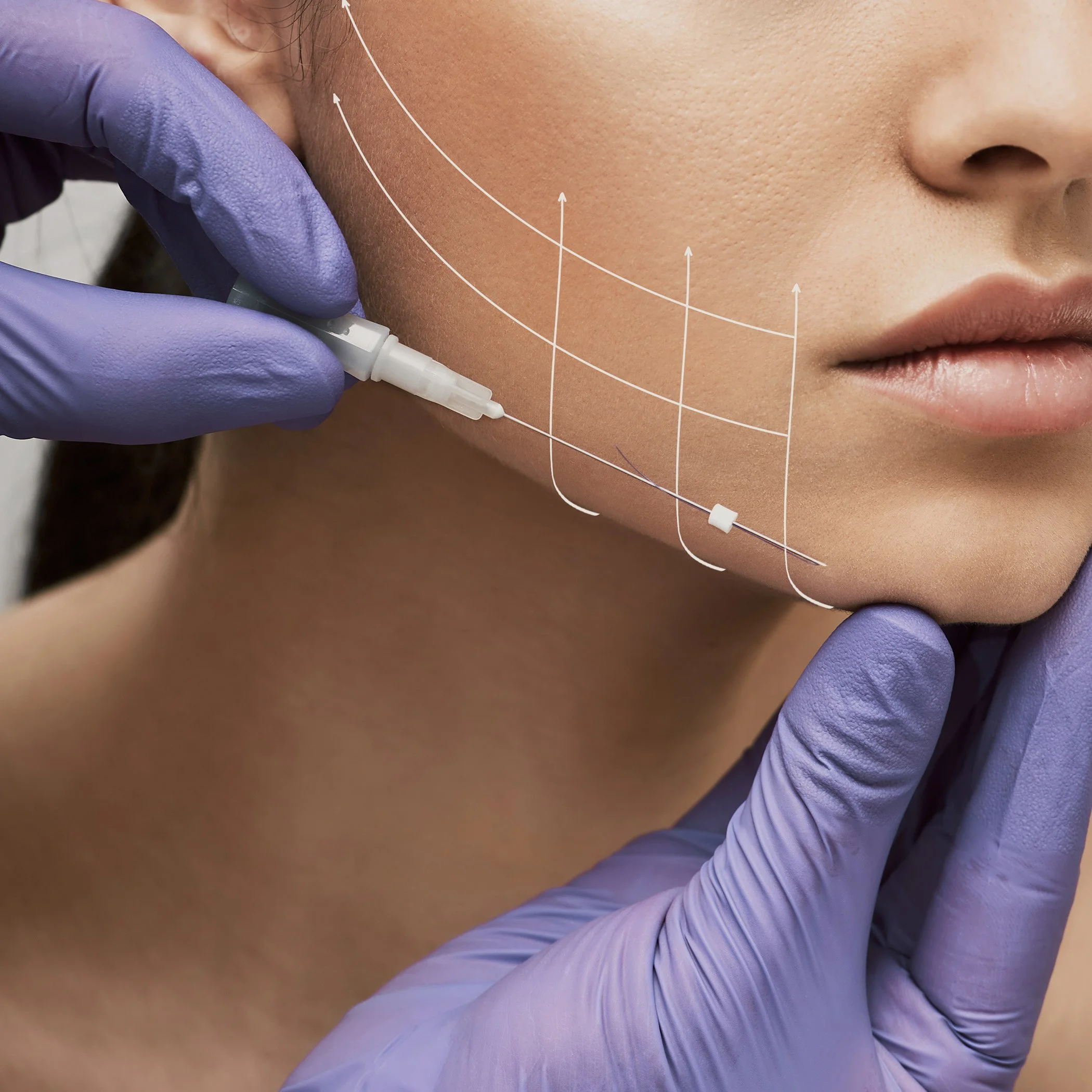 Professional thread lifting procedure and facial rejuvenation