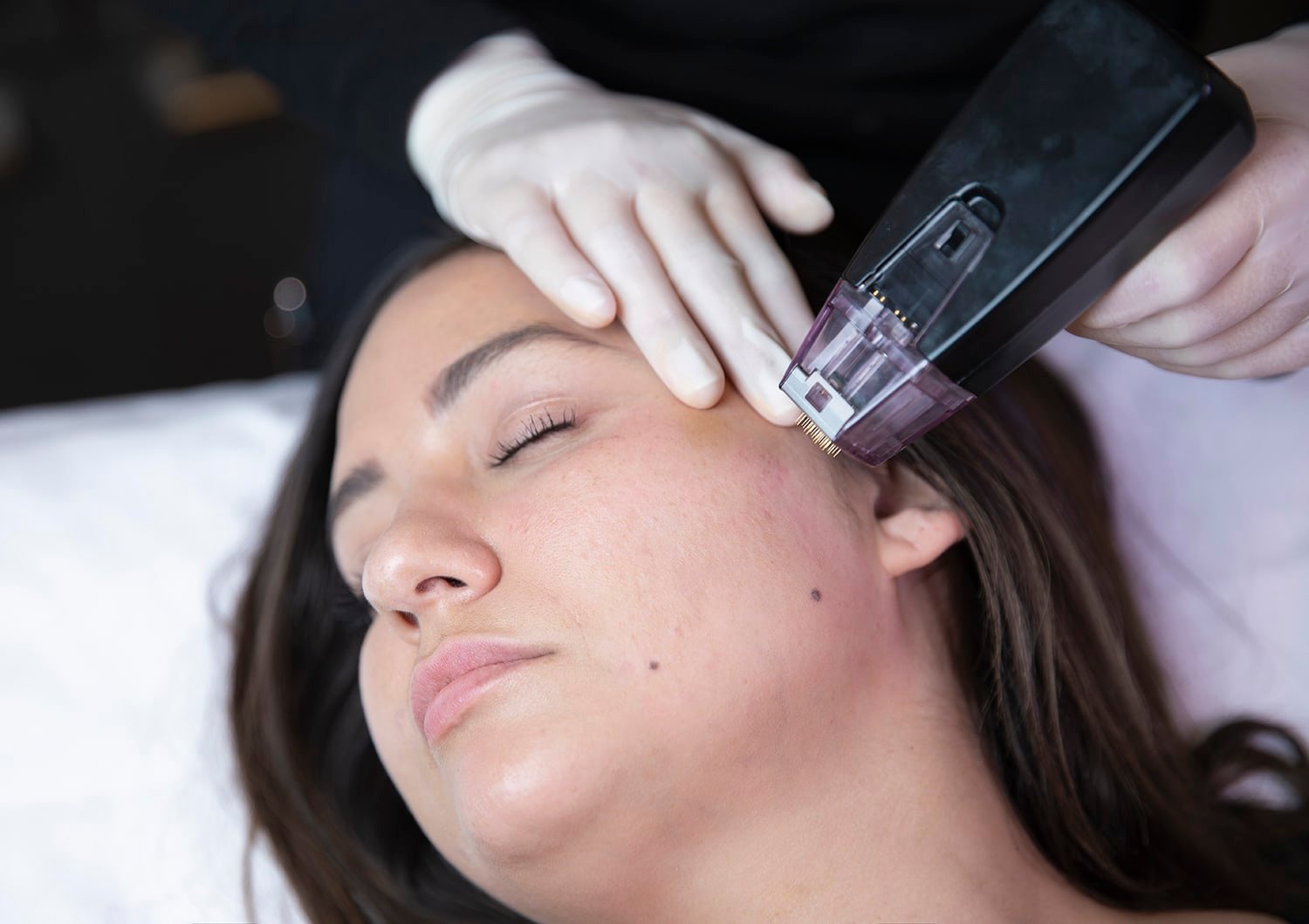 Morpheus8 advanced microneedling radiofrequency procedure