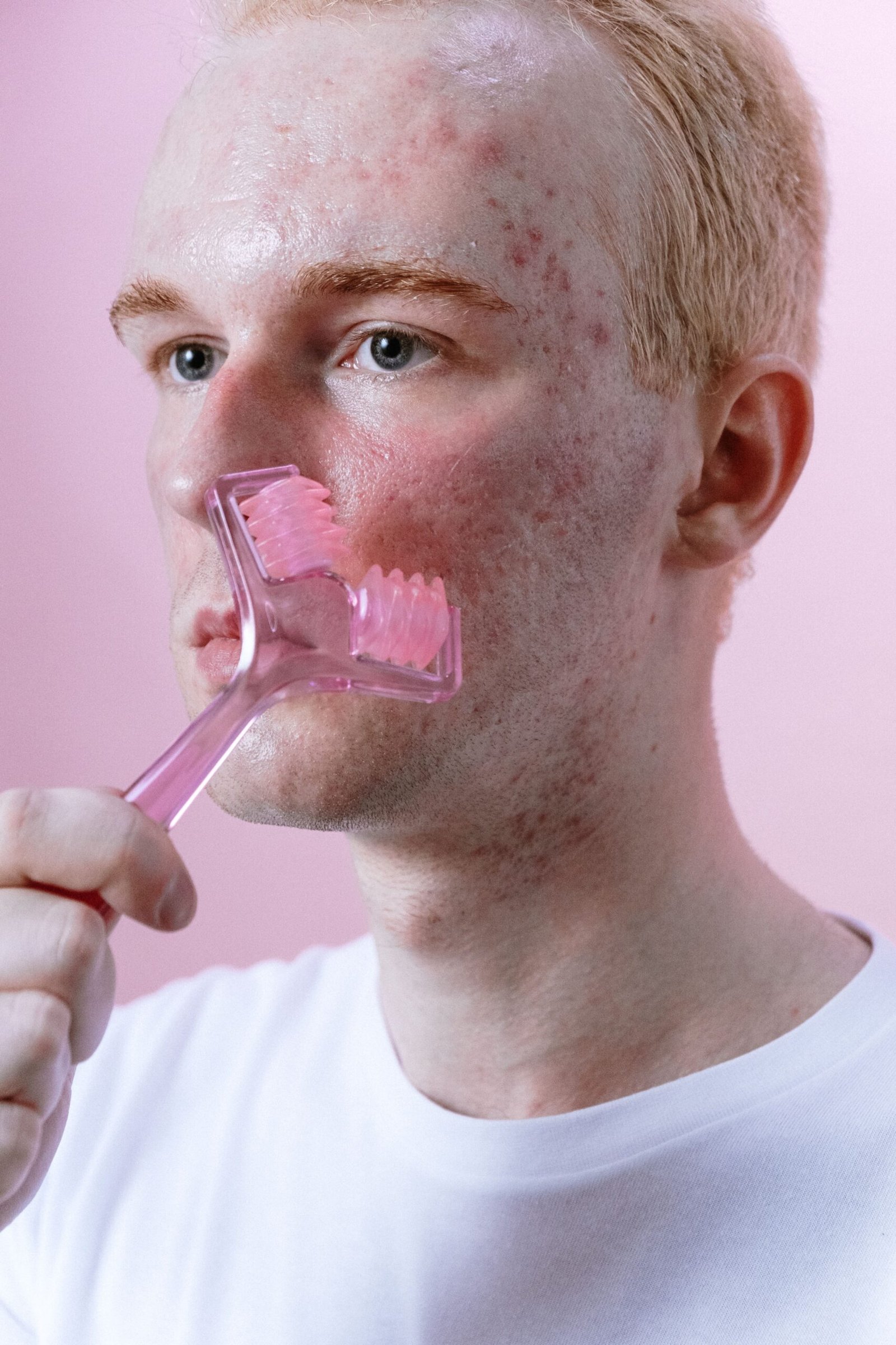 Smooth skin texture results after professional subcision treatments