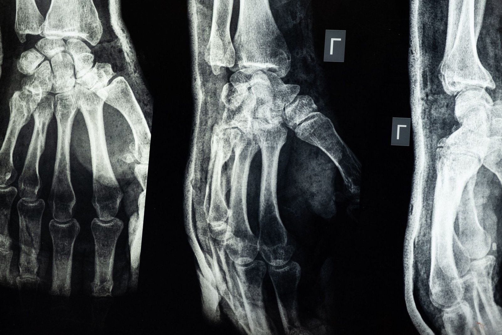 Osteoporosis and osteoarthritis clinical nutrition consultation