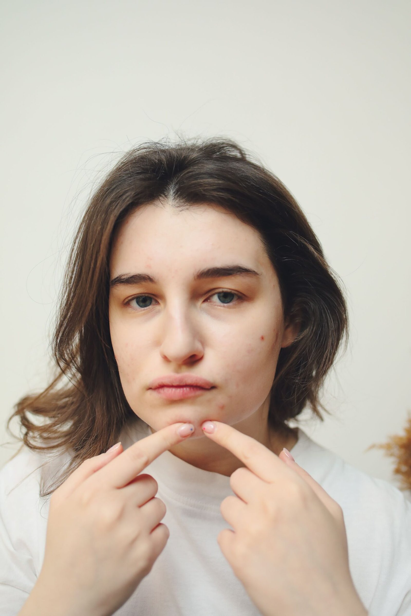 Clear skin after acne treatment