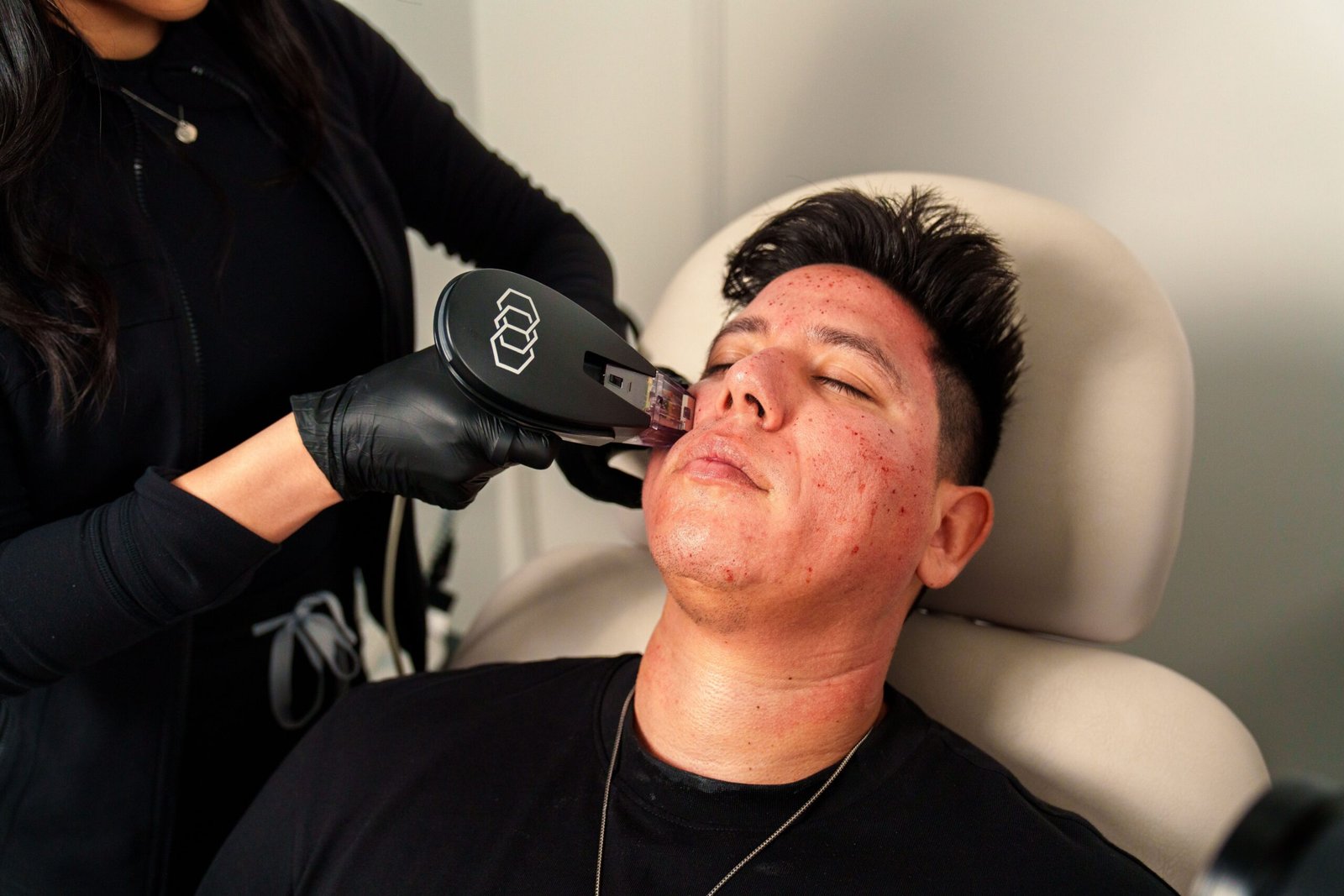 Precision clinical subcision procedure for acne scar release